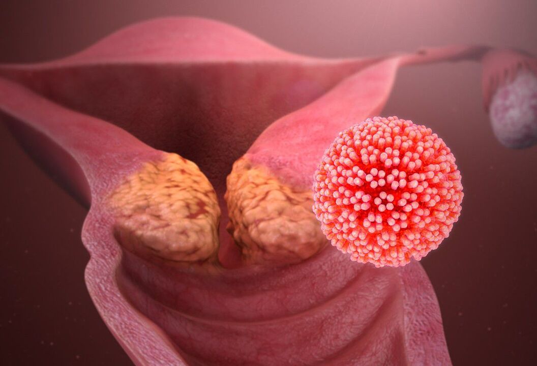 HPV léze děložního čípku