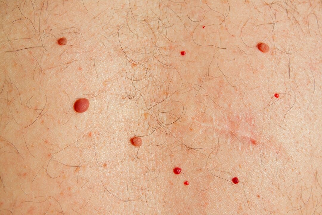Papilomy na těle způsobené HPV