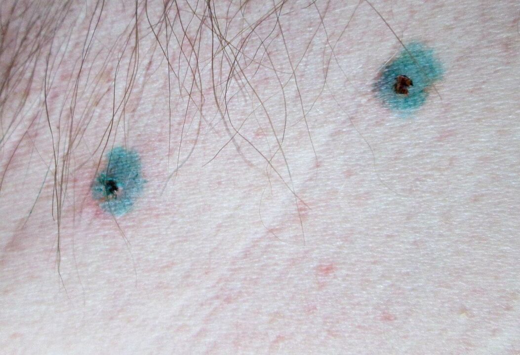 Známky na kůži po laserovém odstranění papilomů