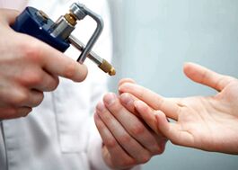 Odstranění bradavice na prstu pomocí tekutého dusíku